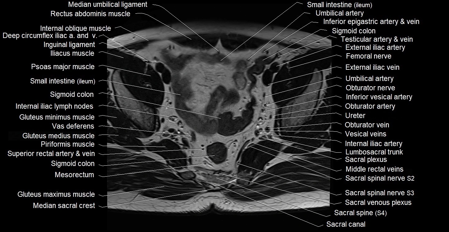 Male pelvis axial cross sectional anatomy image 16.webp
